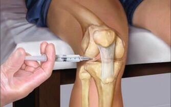 intra-articulaire injectie in het gewricht voor artrose
