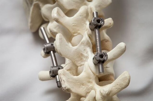 fixatie van de wervelkolom osteochondrose van de nek