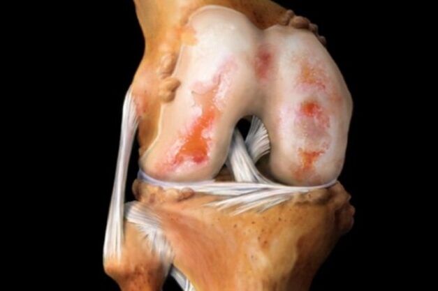 kraakbeenschade bij artrose van de knie