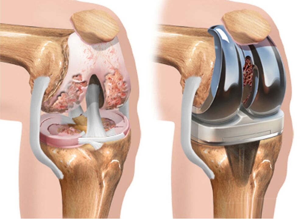 voor en na artrose van het kniegewricht bij artrose