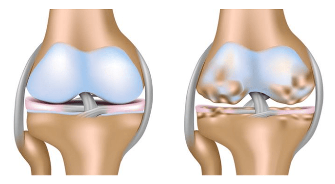 gezond kraakbeen en beschadiging van het kniegewricht bij artrose