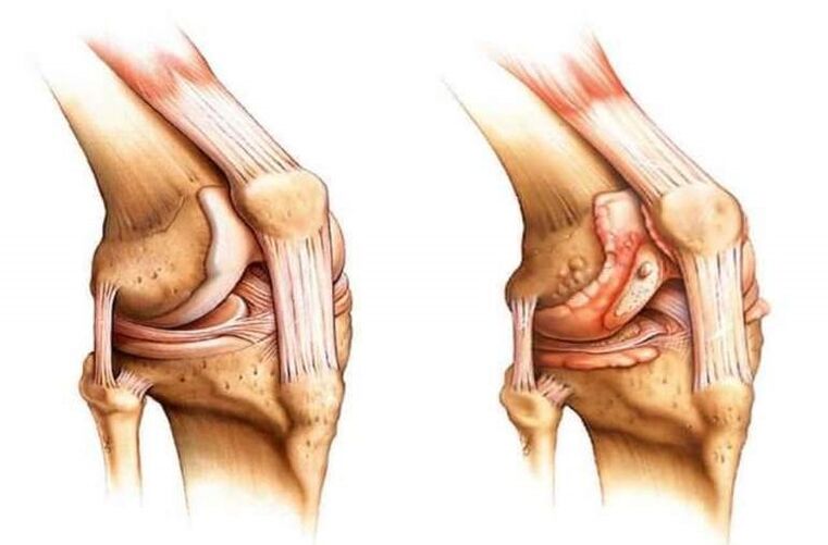 gezonde knie en artrose van het kniegewricht
