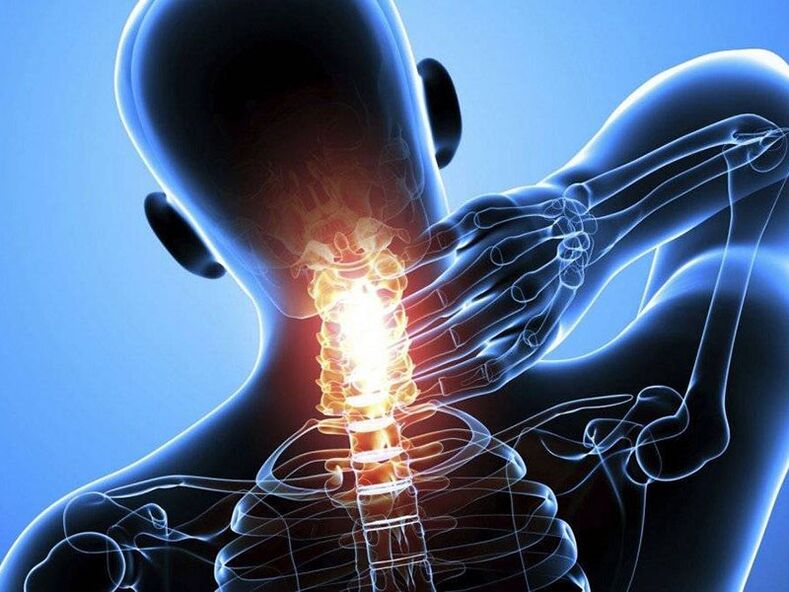 Osteochondrose van de cervicale wervelkolom gaat gepaard met pijn in de nek