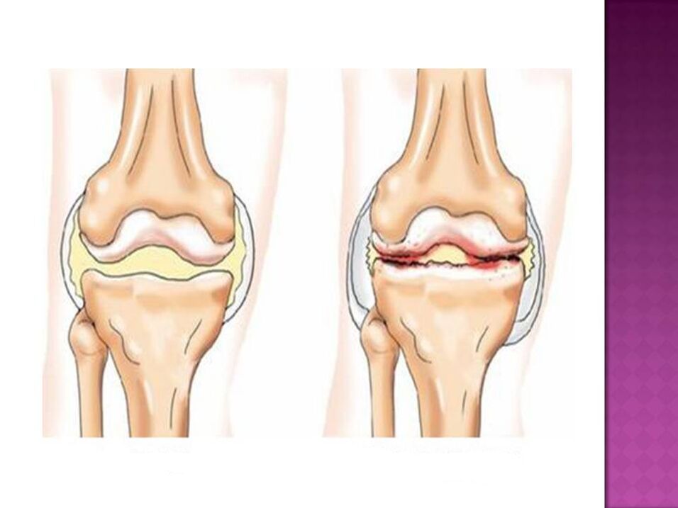 Het gewricht is normaal (links) en aangetast door artrose (rechts)