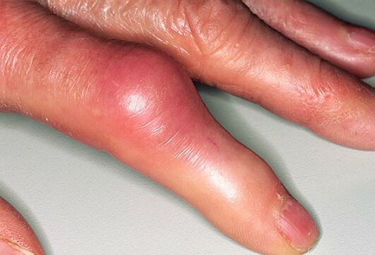 Jicht gaat gepaard met scherpe pijn in de vingers en zwelling van de gewrichten. 