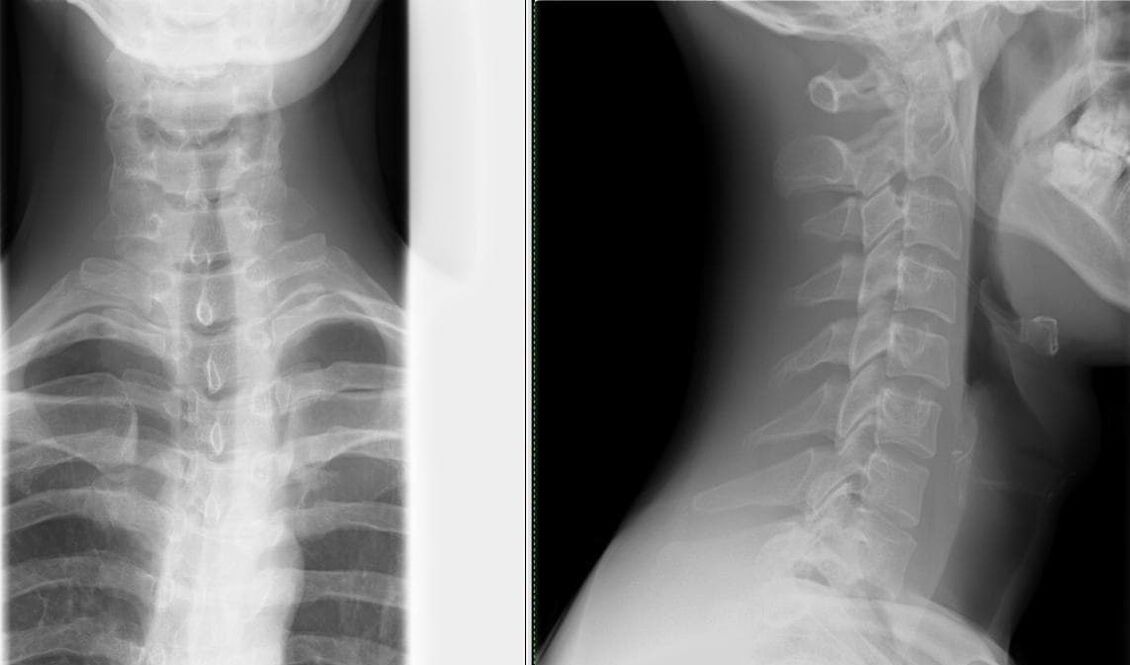 Röntgenfoto van de wervelkolom is een eenvoudige en effectieve methode voor het diagnosticeren van osteochondrose