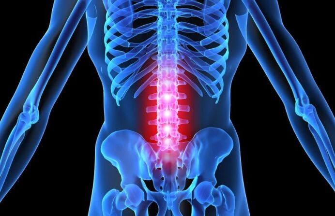 Osteochondrose van het lumbale gebied