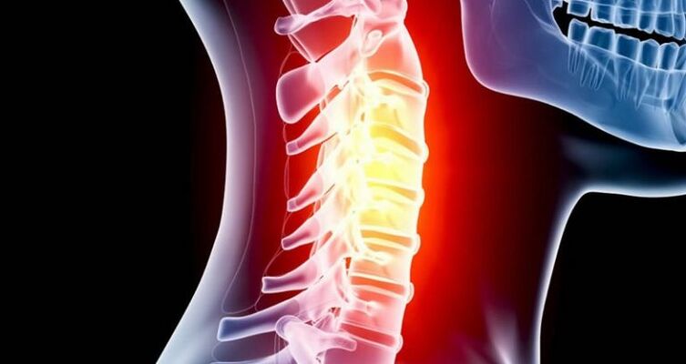 Ontsteking van het cervicale gebied