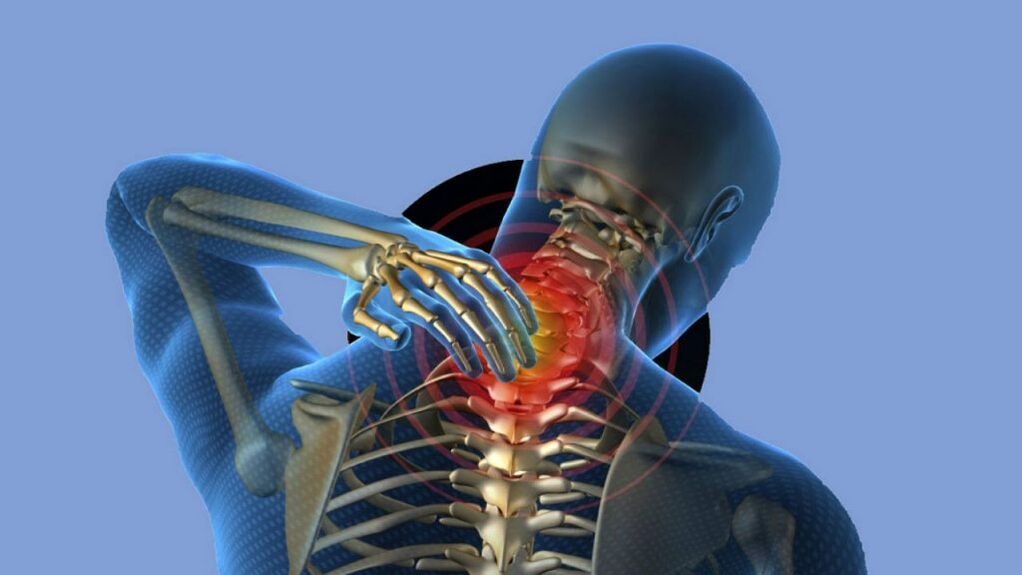 Osteochondrose van het cervicale gebied