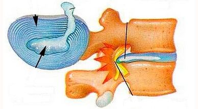 Kenmerken van de ontwikkeling van cervicale osteochondrose